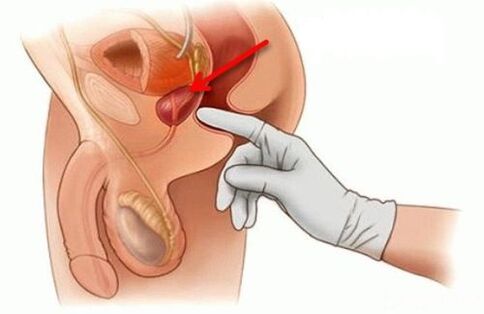 masaža prostate za prostatitis